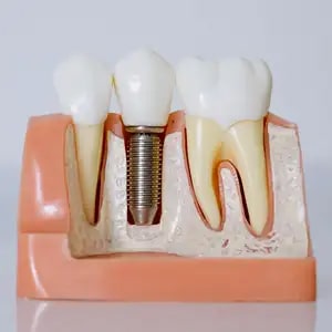 What to Expect from an Implant Dentist in Los Gatos?